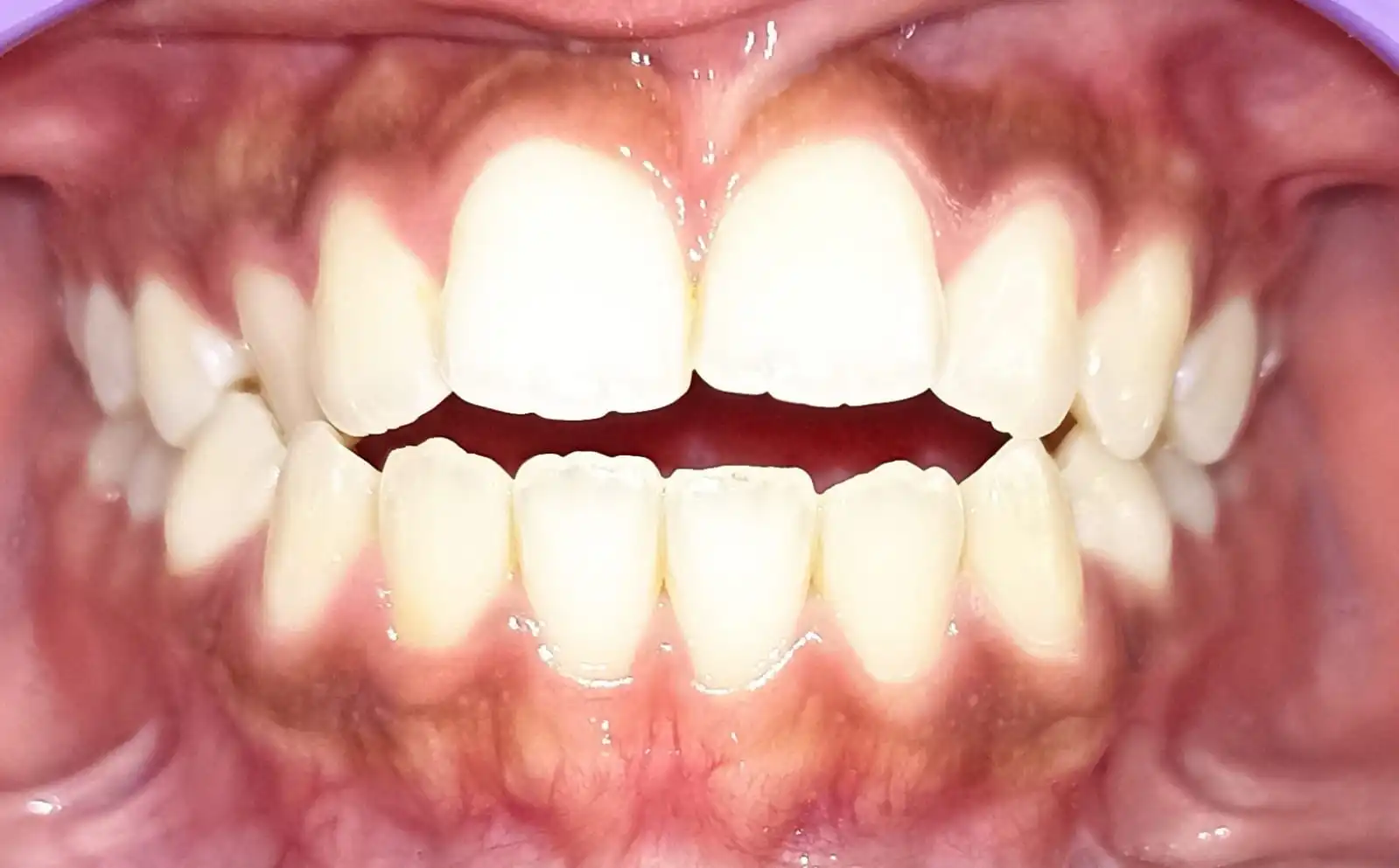 Antes del tratamiento de Brianna